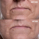 Mouth & Lip Wrinkle Patch