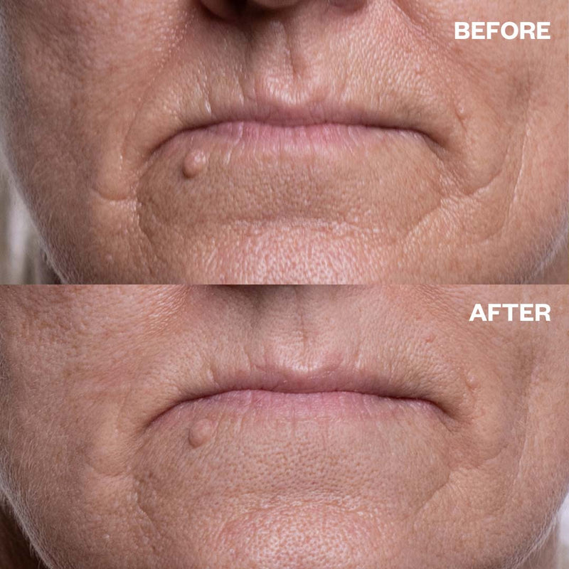 Mouth & Lip Wrinkle Patch